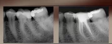 Endodontic treatments (pulpectomy)-arslan-clinic-yusuf-arslan