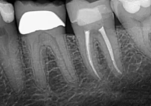 Endodontic treatments (pulpectomy)-arslan-clinic-yusuf-arslan