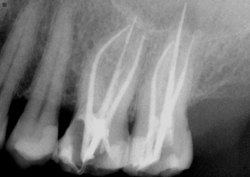 Endodontic treatments (pulpectomy)-arslan-clinic-yusuf-arslan