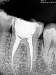 Endodontic treatments (pulpectomy)-arslan-clinic-yusuf-arslan