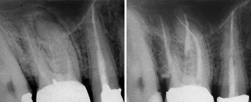 Endodontic treatments (pulpectomy)-arslan-clinic-yusuf-arslan