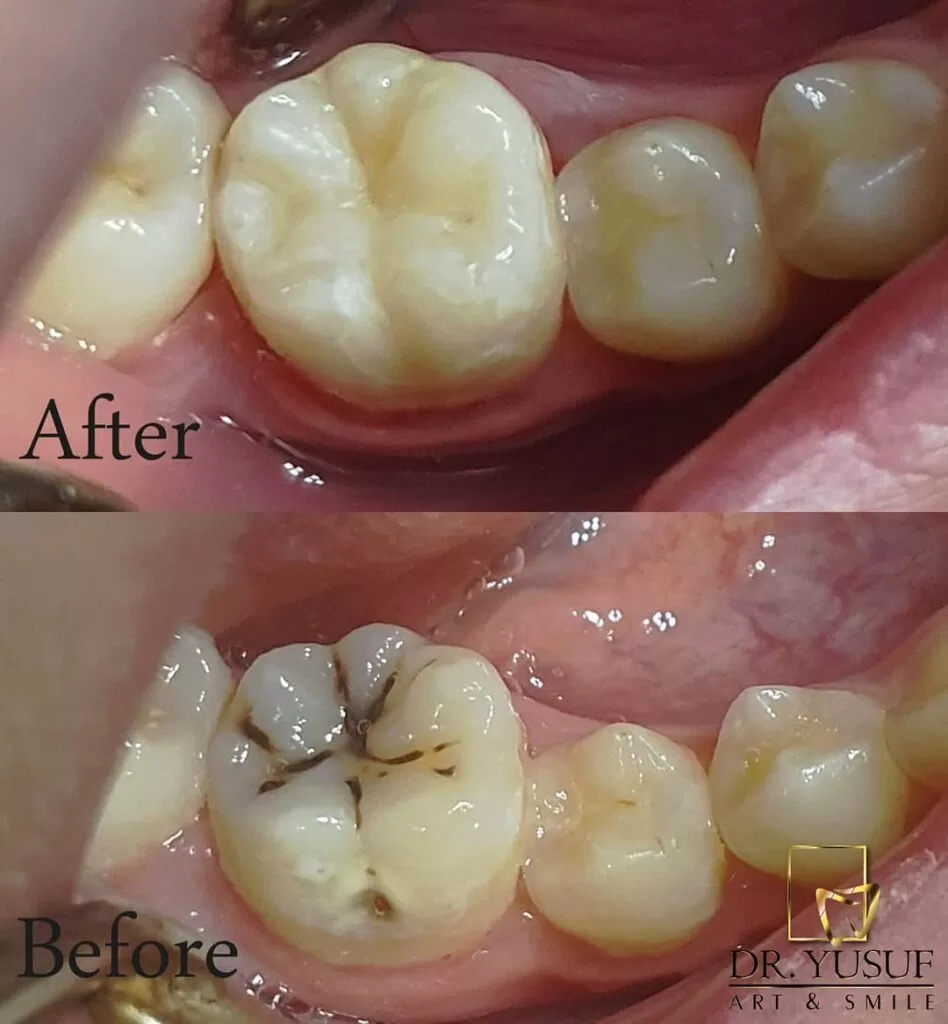 Restorative dental treatment (dental fillings)-arslan-klinik-yusuf-arslan