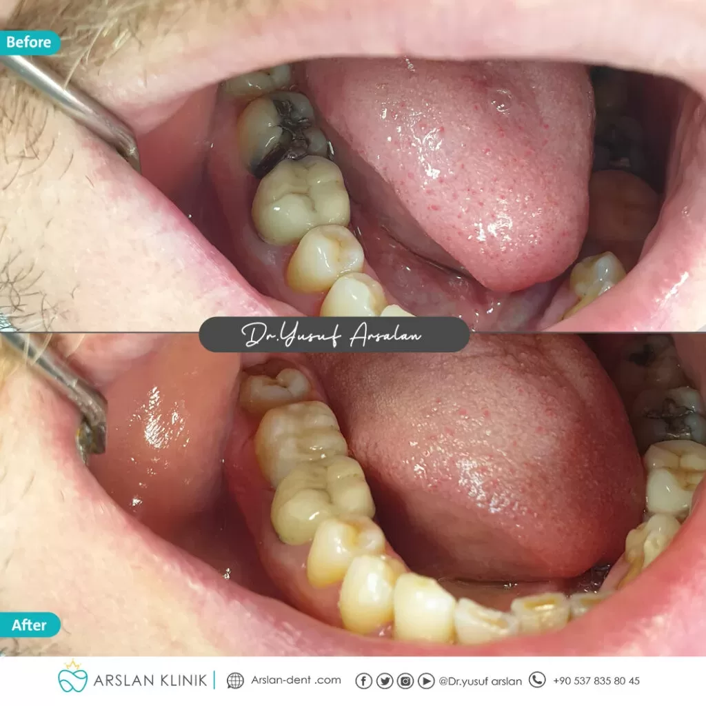 Restorative dental treatment (dental fillings)-arslan-klinik-yusuf-arslan