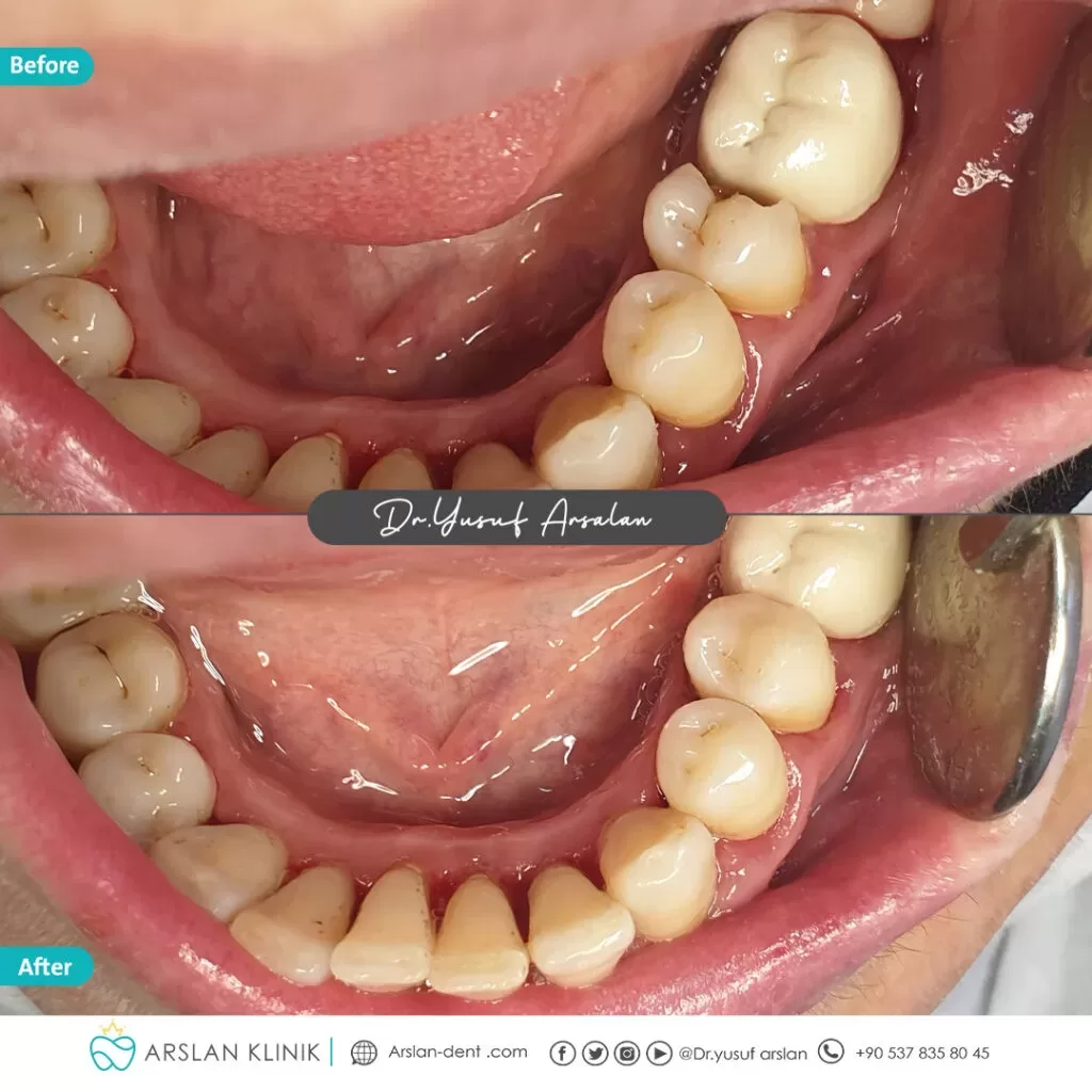 Restorative dental treatment (dental fillings)-arslan-klinik-yusuf-arslan