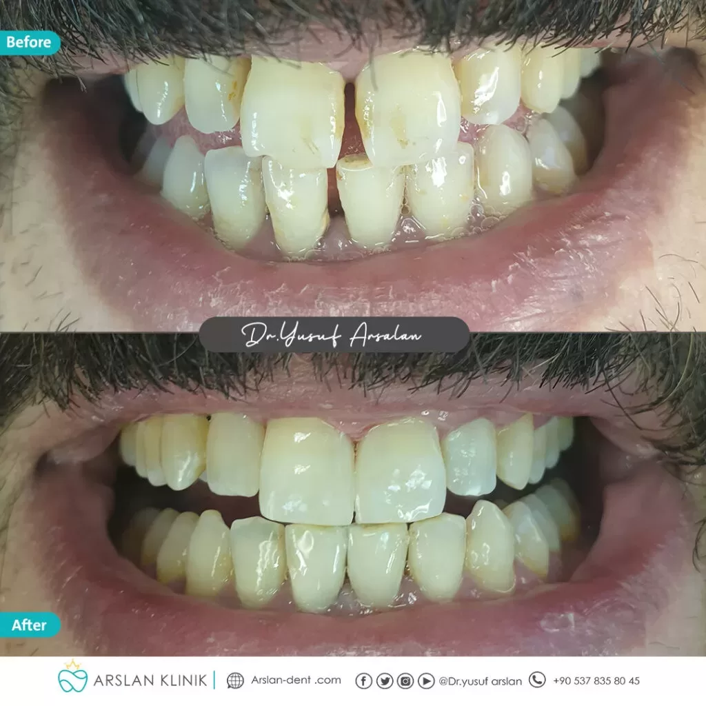 Restorative dental treatment (dental fillings)-arslan-klinik-yusuf-arslan