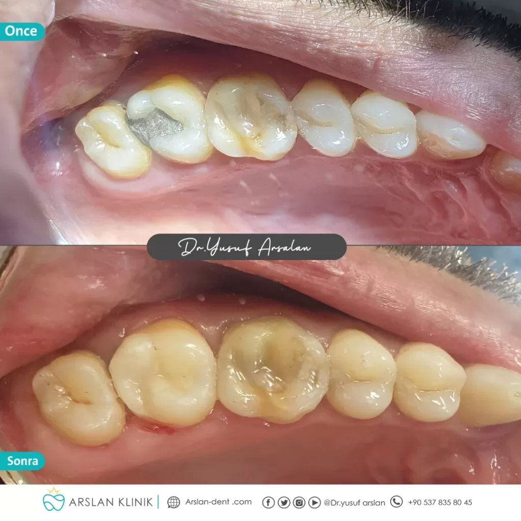 Restorative dental treatment (dental fillings)-arslan-klinik-yusuf-arslan