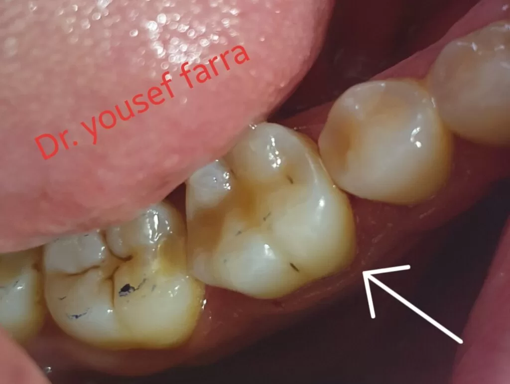 Restorative dental treatment (dental fillings)-arslan-klinik-yusuf-arslan