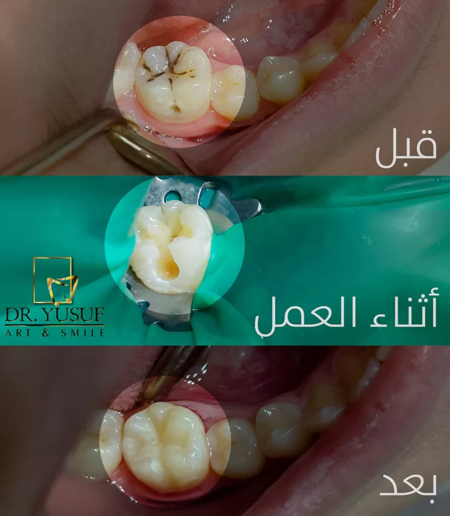 Restorative dental treatment (dental fillings)-arslan-klinik-yusuf-arslan