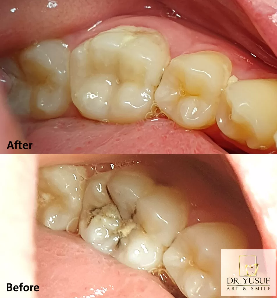 Restorative dental treatment (dental fillings)-arslan-klinik-yusuf-arslan