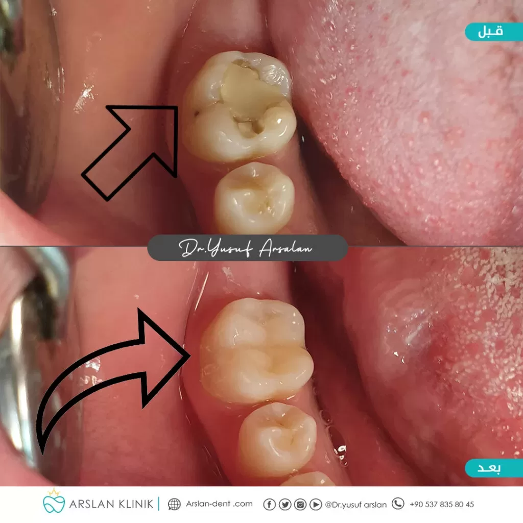 Restorative dental treatment (dental fillings)-arslan-klinik-yusuf-arslan