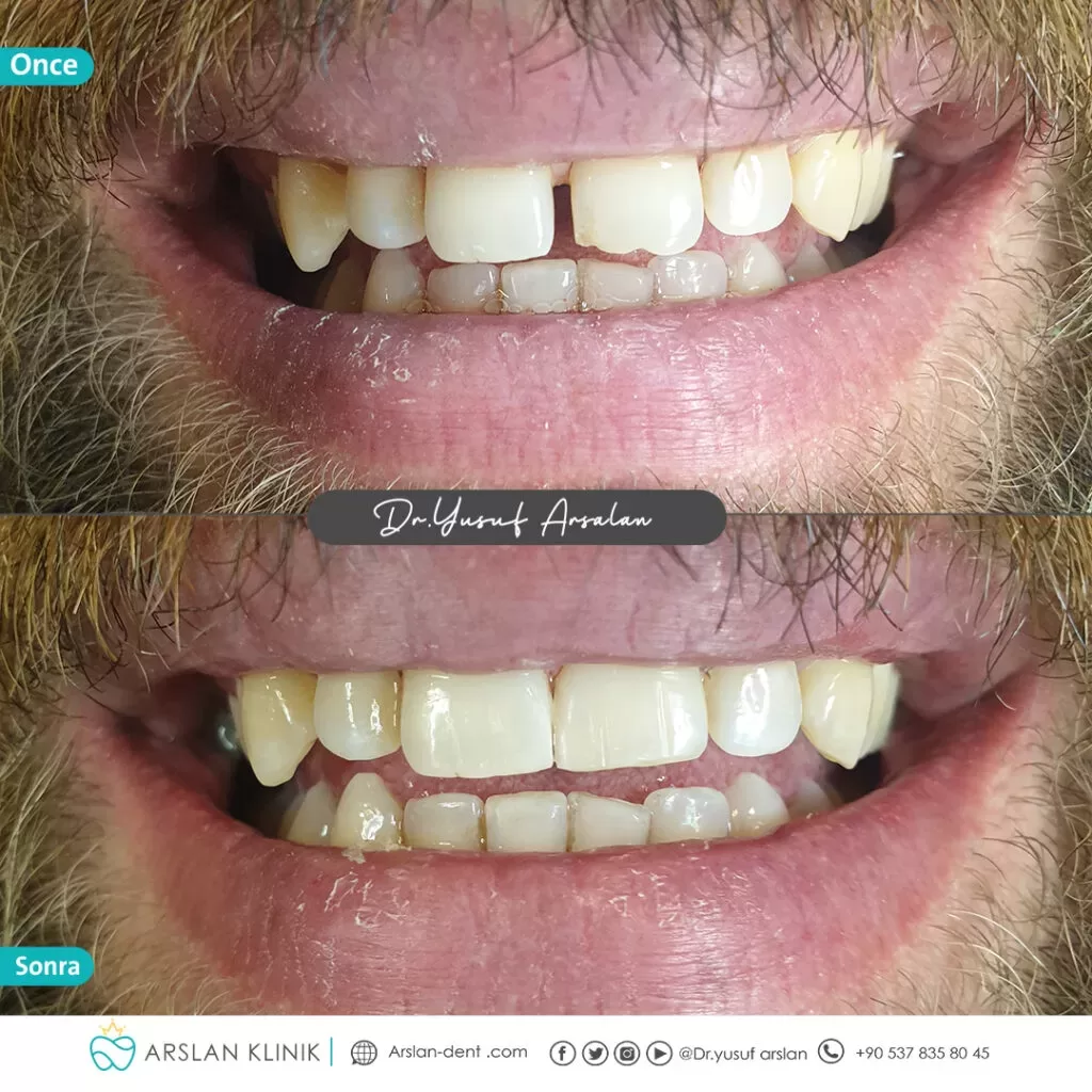 Restorative dental treatment (dental fillings)-arslan-klinik-yusuf-arslan