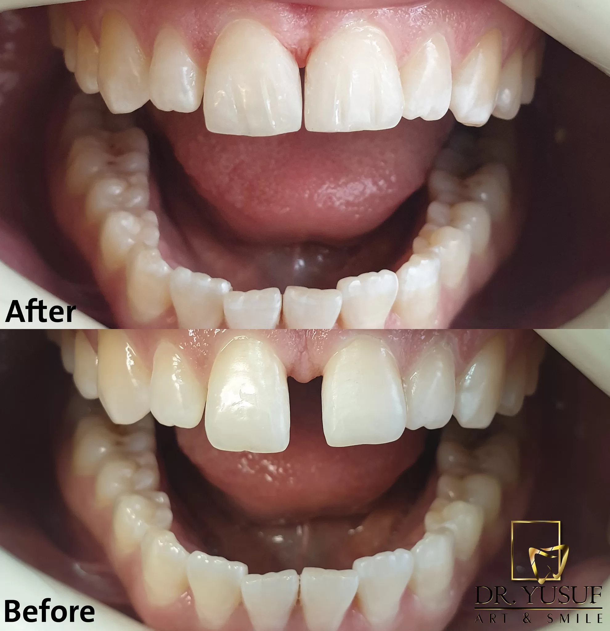 Restorative dental treatment (dental fillings) - arslan klinik