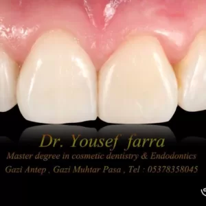 crowns-and-bridges-arslan-dental-klinik-yusuf-arslan