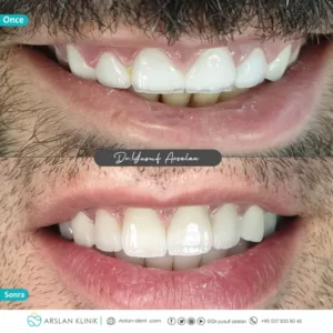 crowns-and-bridges-arslan-dental-klinik-yusuf-arslan-18