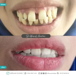 crowns-and-bridges-arslan-dental-klinik-yusuf-arslan-27