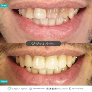 crowns-and-bridges-arslan-dental-klinik-yusuf-arslan-28