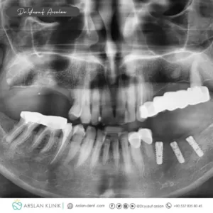 dental-implants-arslan-klinik-yusuf-arslan