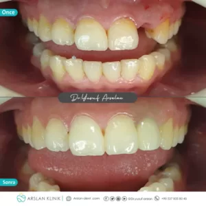 dental-implants-arslan-klinik-yusuf-arslan