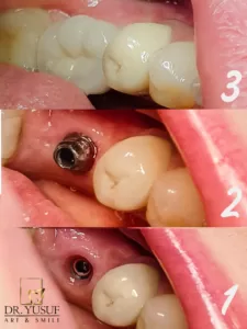 dental-implants-arslan-klinik-yusuf-arslan