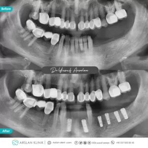 dental-implants-arslan-klinik-yusuf-arslan