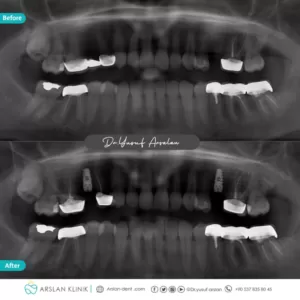 dental-implants-arslan-klinik-yusuf-arslan