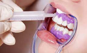 teeth-whitening-arslan-dental-klinik-yusuf-arslan