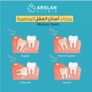 wisdom-tooth-pain-arslan-dental-klinik-yusuf-arslan